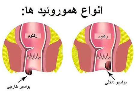 
			
		بواسیر یا (هموروئید) و شقاق و روش های درمان سرپائی
		