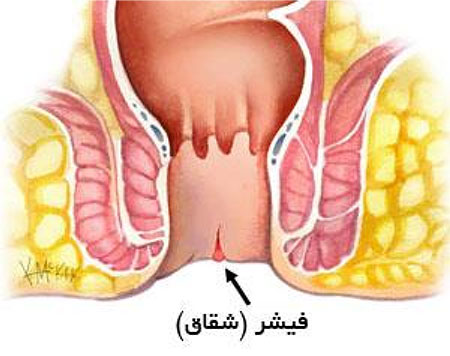 بواسیر,هموروئید,شقاق