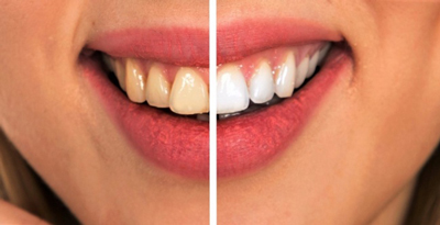 
			
		8 راه ساده و طبیعی برای کاهش پوسیدگی دندان
		