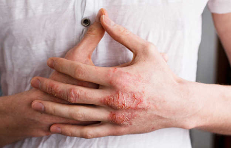 علائم حساسیت به لاتکس کاندوم, پماد برای حساسیت پوستی, تشخیص آلرژی به لاتکس