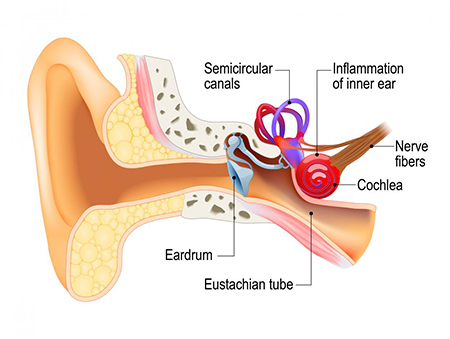 التهاب گوش میانی, عفونت گوش میانی, نوریت وستیبولار