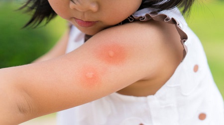 
			
		درمان و پیشگیری از نیش زدن پشه در کودکان
		روش‌های پیشگیری و درمان نیش پشه در نوزادان و کودکان