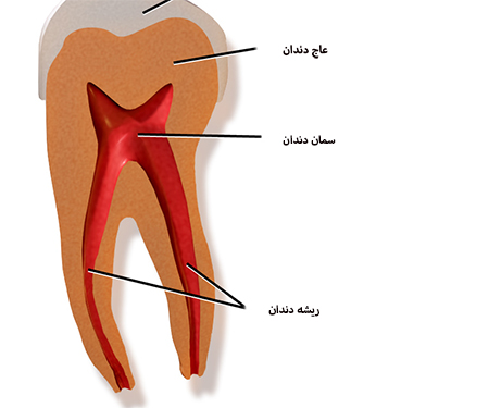 ایمپلنت دندان نیش نهفته, عوارض ایمپلنت دندان نیش, ایمپلنت دندان نیش