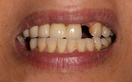فواید ایمپلنت دندان نیش, پوسیدگی دندان, ایمپلنت دندان نیش چیست