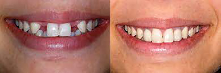 پوسیدگی دندان, ایمپلنت دندان نیش چیست, مزایای کاشت ایمپلنت نسبت به دندان مصنوعی