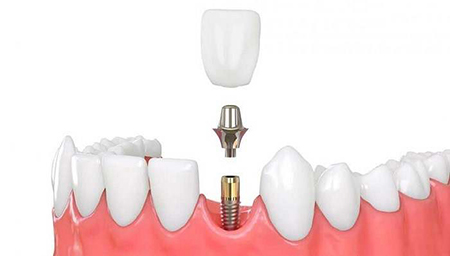  مراقبت‌های بعد از ایمپلنت دندان نیش, هزینه کاشت ایمپلنت نیش دندان, ایمپلنت دندان نیش نهفته