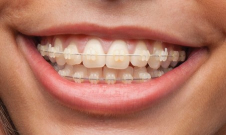 ارتودنسی همرنگ دندان, ارتودنسی با براکت های هم رنگ دندان