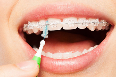 ارتودنسی همرنگ دندان, ارتودنسی با براکت های هم رنگ دندان