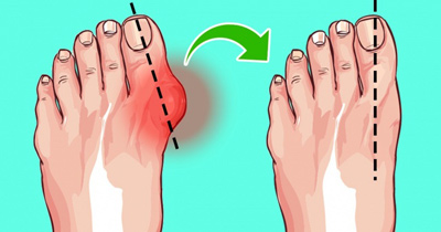 
			
		6 راه آسان برای درمان پینه پا بدون جراحی
		