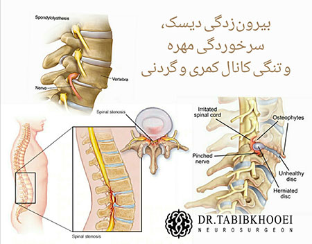 جراحی ستون فقرات جراحی مغز و اعصاب,جراح مغز و اعصاب در ایران