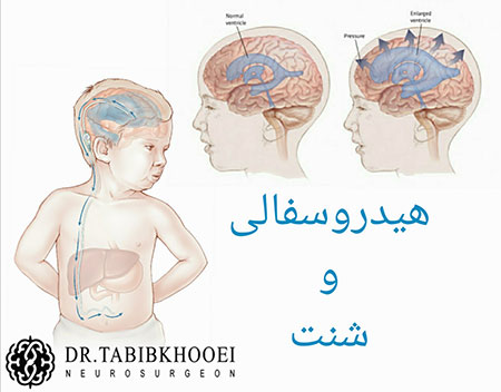 عارضه هیدروسفالی جراحی مغز و اعصاب,جراح مغز و اعصاب در ایران
