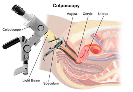 
			
		کولپوسکوپی رحم چیست؟
		