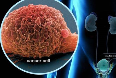 عوارض درمان‌های سرطان مثانه, انتقال سرطان مثانه به نقاط دیگر در بدن