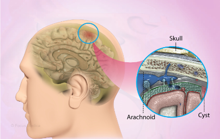 بسیاری از کیستهای آراکنوئید هیچ علائمی ایجاد نمیکنند کیست آراکنوئید, علائم کیست آراکنوئید