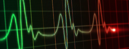 سندرم بروگادا یک وضعیت پزشکی نادر است سندرم بروگادا, علائم سندرم بروگادا, انواع سندرم بروگادا