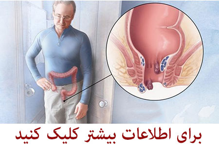 جراحی هموروئید جراحی هموروئید,جراحی بواسیر,جراحی بواسیر با لیزر