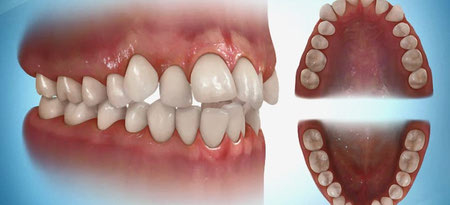 
			
		کراودینگ دندان چیست و چگونه درمان می شود؟
		روشهای درمان کراودینگ یا نامرتبی دندان 