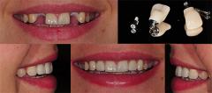 
			
		چگونه دندان نیش از دست رفته را جایگزین کنید؟ (ایمپلنت دندان نیش)
		ایمپلنت دندان نیش به چه صورت است؟
