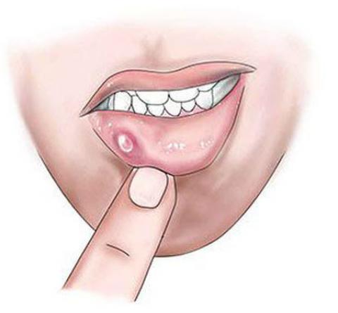 
			
		پیشگیری و درمان موکوسل دهانی
		موکوسل دهانی چیست و چگونه درمان می شود؟ 