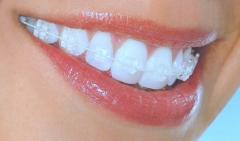 ارتودنسی همرنگ دندان: درمان ارتودنسی با ظاهری طبیعیمزایا و معایب ارتودنسی های همرنگ دندانچه کسانی کاندیدای خوبی برای ارتودنسی های سرامیکی است؟طول درمان ارتودنسی همرنگ دندان آیا ارتودنسی های سرامیکی لکه دار می شوند؟سوالات متداول درباره ارتودنسی همرنگ دندانسخن نهایی