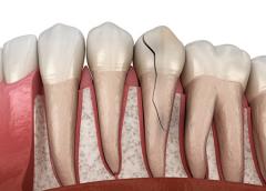 
			
		چه چیزی باعث ایجاد شقاق دندان می شود؟
		علل، علایم و راههای درمان شقاق دندانی 