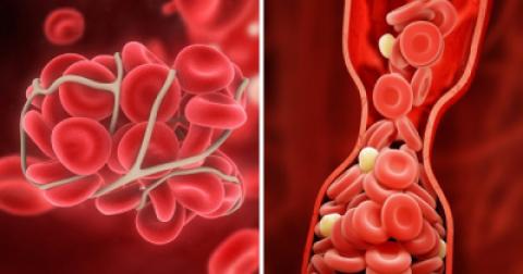 
			
		10 راه برای جلوگیری از لخته شدن خون
		