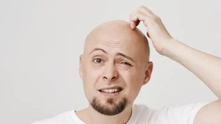داروهای ضد التهابی پس از کاشت مو