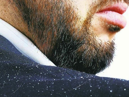 
			
		راه حل های سریع برای رفع شوره ریش آقایان
		آنچه که باید درباره شوره ریش آقایان بدانید