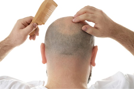 داروی ضد ریزش مو ارثی مردان, برای جلوگیری از ریزش مو ارثی, داروی جلوگیری از ریزش مو ارثی