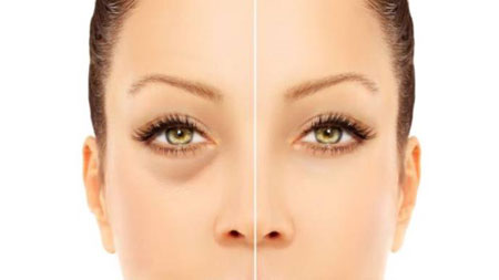 
			
		پف زیر چشم چیست و چگونه از شرش خلاص شویم؟
		علت و روش های درمان پف زیر چشم