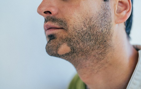 دلایل ریزش ریش صورت, درمان ریزش ریش, علت ریزش ریش صورت