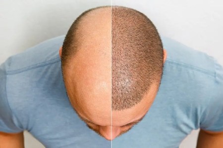 کاشت مو به روش fit کاشت مو به روش fit