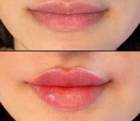 تزریق ژل لب برای حجم&zwnj;دهی