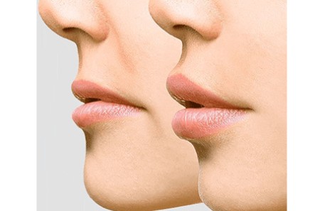 بهترین روشهای آرایشی رفع افتادگی گوشه لب بهترین روشهای آرایشی رفع افتادگی گوشه لب