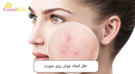 علل ایجاد جوش روی صورت