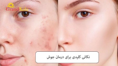 نکاتی کلیدی برای درمان جوش