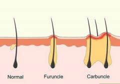 
			
		کفگیرک پوست: علل، علایم، پیشگیری و درمان
		همه چیز درباره کفگیرک یا کربونکل پوست 