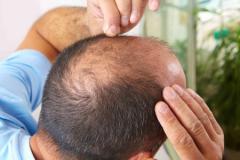 
			
		ریزش موی ارثی: چگونه ژنتیک بر ریزش مو تأثیر می گذارد
		چگونه با ریزش موی ژنتیکی مبارزه کنیم