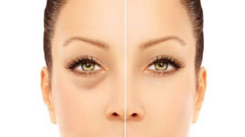 
			
		پف زیر چشم چیست و چگونه از شرش خلاص شویم؟
		علت و روش های درمان پف زیر چشم