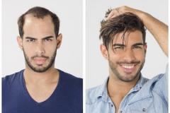  پروتز مو چیست؟  پروتز مو برای چه کسانی مناسب است؟  آشنایی با بهترین کلینیک ترمیم مو و پروتز مو  نیم ‌نگاهی به چند کلینیک پروتز و ترمیم مو  جمع‌بندی 