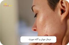 علل ایجاد جوش روی صورت چطور جوش و آکنه صورت را در خانه درمان کنیم؟نکاتی کلیدی برای درمان جوش و آکنه صورت در خانهسخن پایانی