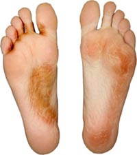 
			
		بیماری پای ورزشكاران‌ ( Athlete's foot )
		