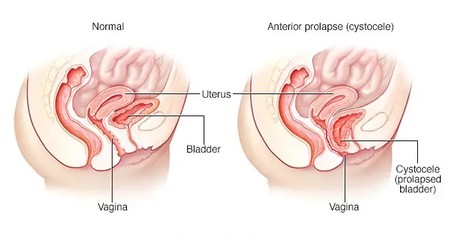 ورزش های مخصوص افتادگی رحم و مثانه درمان افتادگی رحم, ورزش برای افتادگی رحم, همه چیز در مورد افتادگی رحم