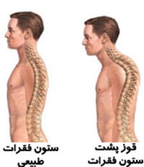 
			
		درمان قوز پشتی با چند حرکت ورزشی (+ تصاویر)
		